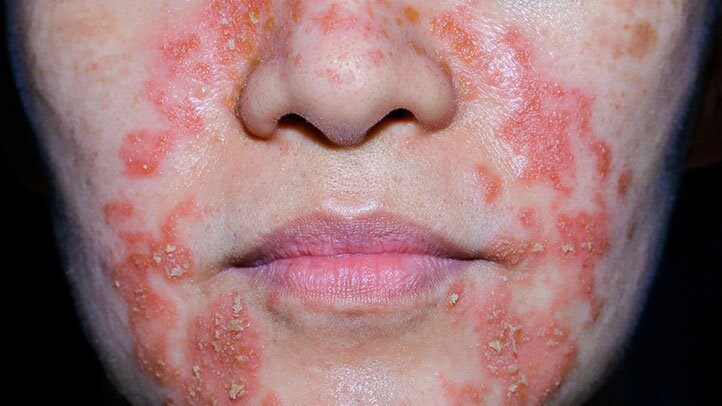 Red scaling eczema in a woman's face